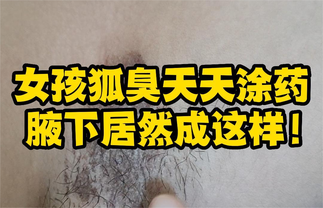  女(nǚ)孩狐臭天天塗藥，腋下(xià)成這(zhè)樣！
